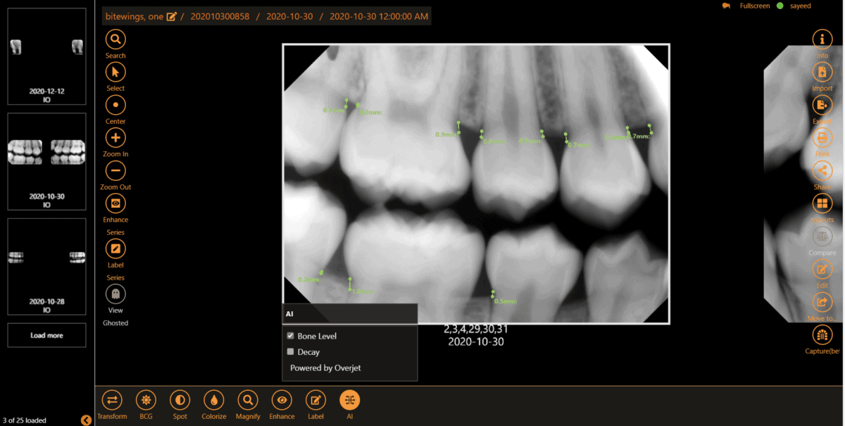 Apteryx AI diagnosing periodontal disease