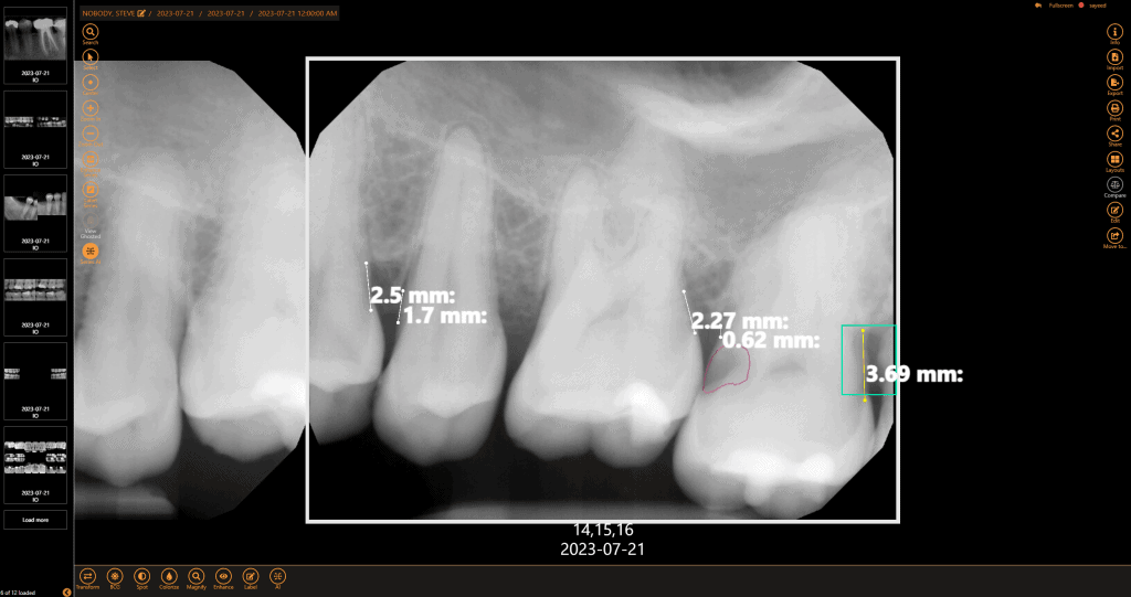 Get a second opinion to help diagnose decay, identify tarter build-up, and highlight bone levels to assist in diagnosing periodontal disease with our dental imaging AI.