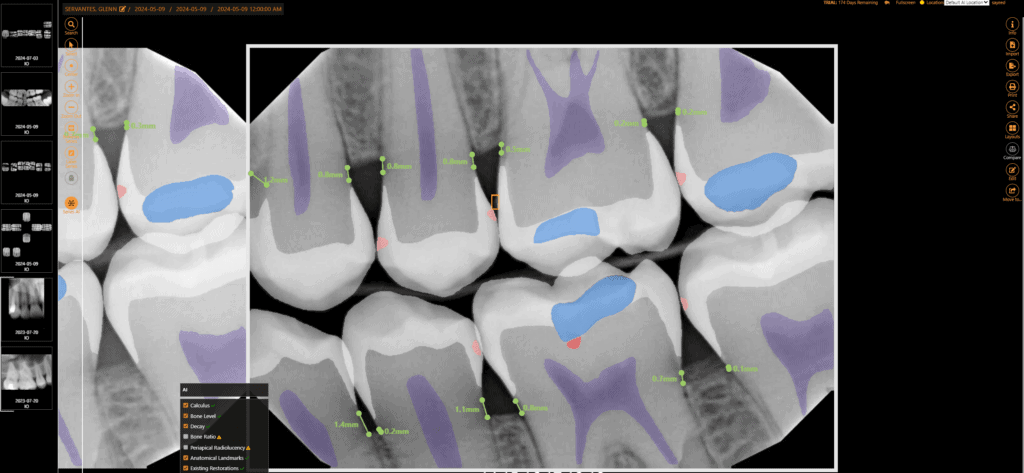 FDA-cleared dental AI analysis and overlays to help you educate your patients.